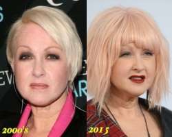 Cyndi Lauper before surgery